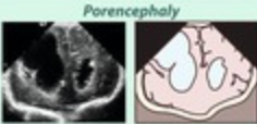 Porencefalia fetal