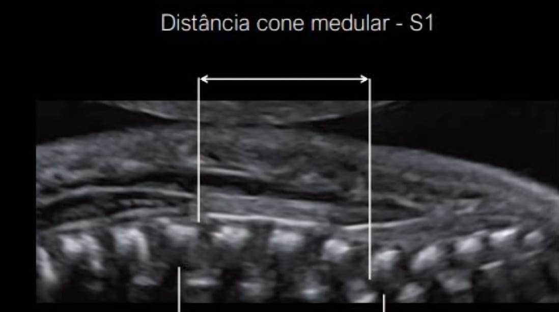 Medida ultrassonográfica da distância entre o cone medular e S1