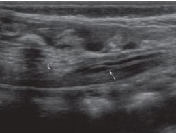 Lipomielomeningocele fetal ao ultrassom